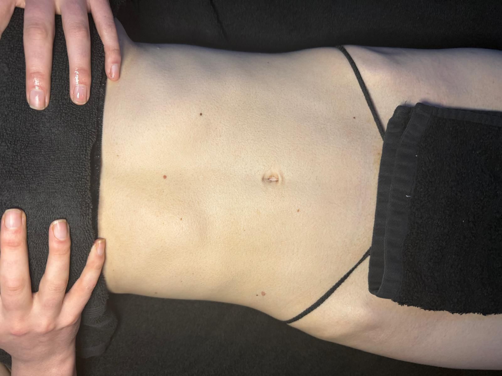 Post-operative drainage (lipo 360)
